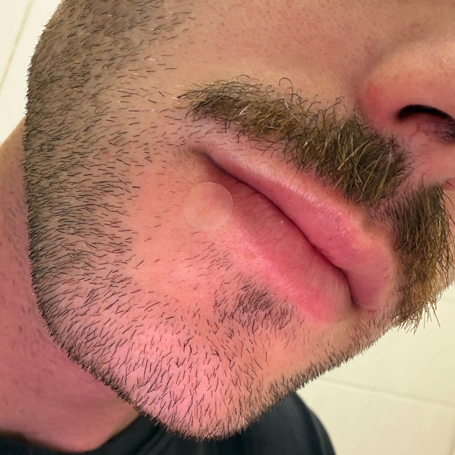 Chin Pimples: The Causes and What Really Helps