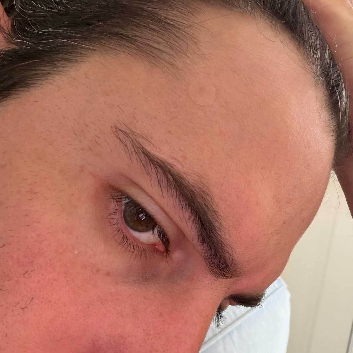 Close-up of a forehead with a barely visible bump under the skin
