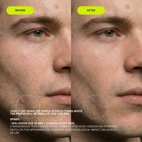 JAWLINER® Pimple Patch