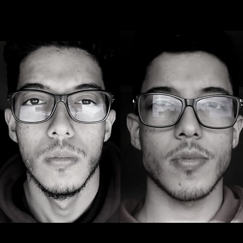 Hollow Cheeks and Your Jawline